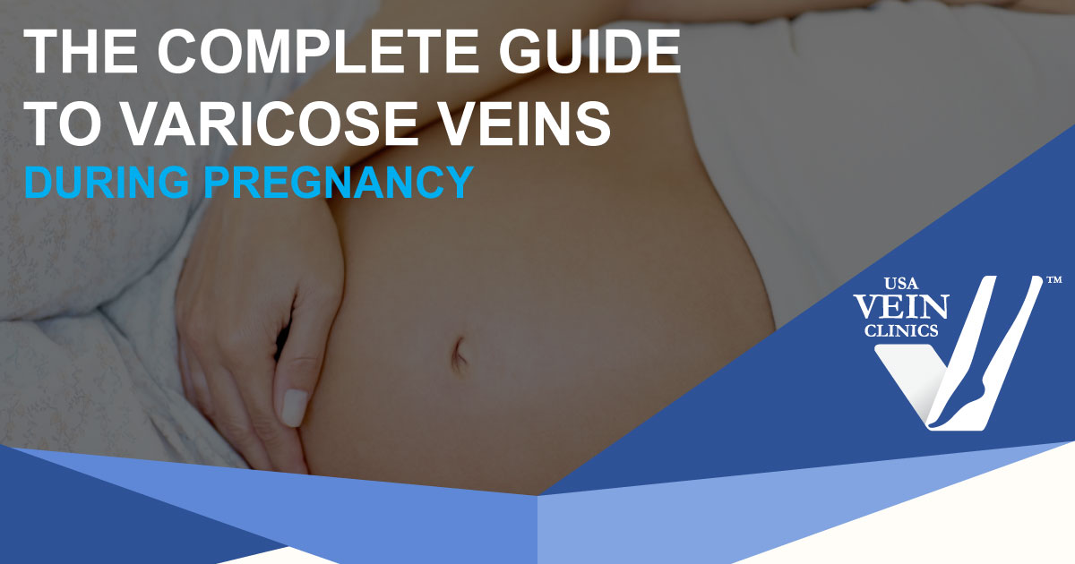 Varicose Veins During Pregnancy The Complete Guide