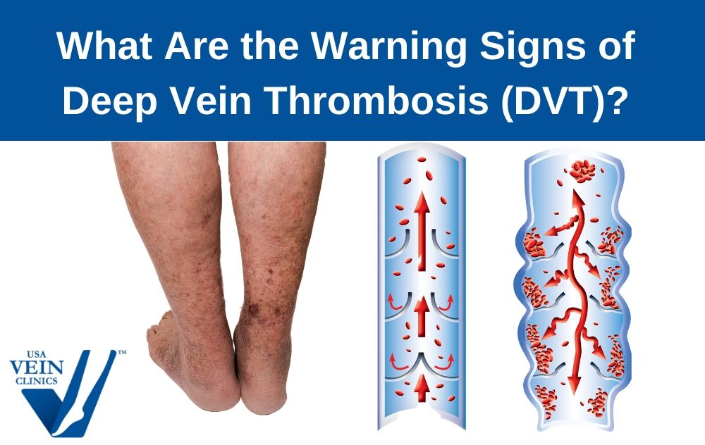 Deep Vein Thrombosis Dvt Warnings Signs Treatment Images