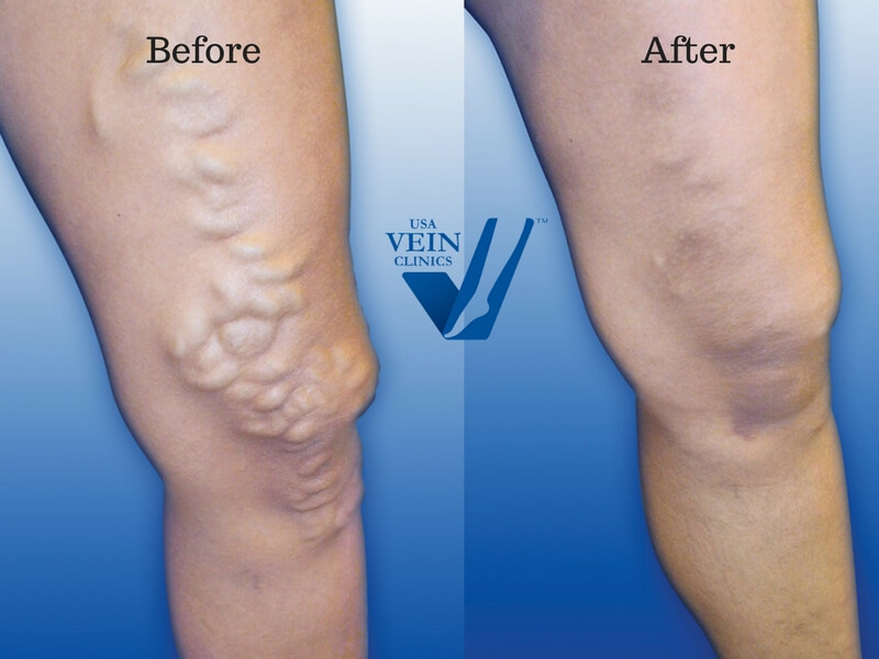 Varicose Vein Treatment Center At Usa Vein Clinics 