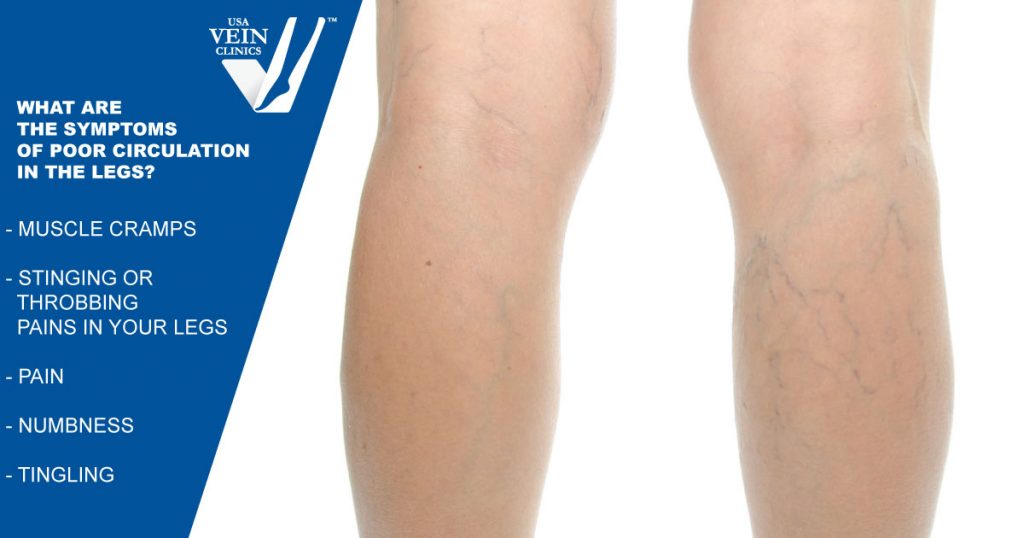 how-to-improve-blood-circulation-in-legs-usa-vein-clinics