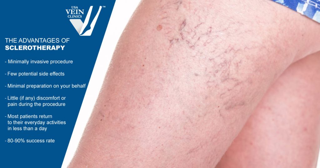 Sclerotherapy Vs Endovenous Laser Therapy What You Need To Know 5550