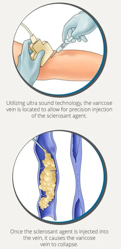 Sclerotherapy (spider Veins)  Sima Medical & Cosmetic Clinic