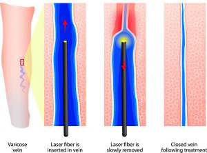Surgery-free treatment for varicose veins