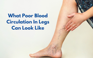 Blog | USA Vein Clinics