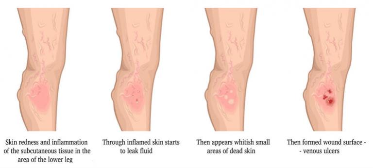 Venous Ulcer Symptoms Treatment And Leg Ulcer Stages 3075