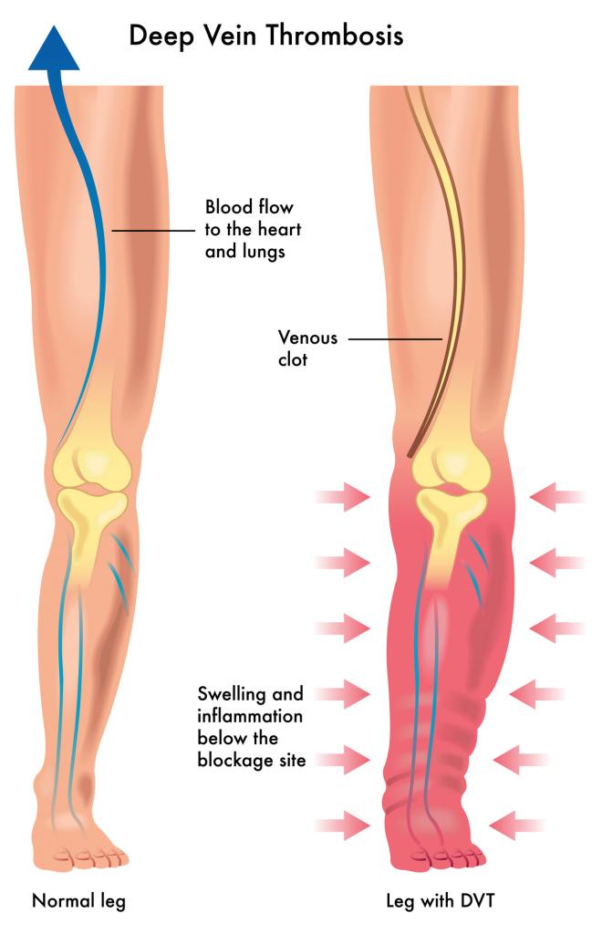 What Is Deep Vein Thrombosis (DVT)? Here Are Its Symptoms, Causes
