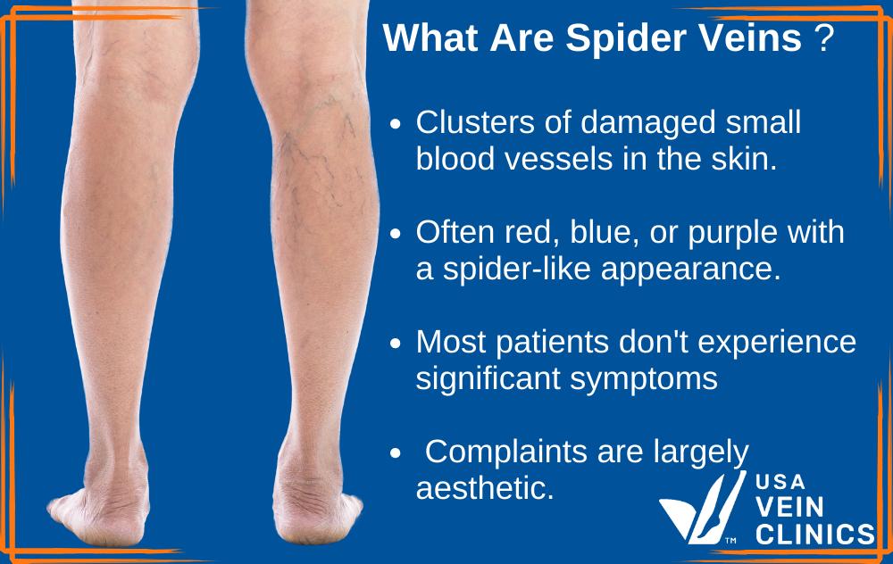 Spider Vein Guide: Causes, Prevention & Treatment
