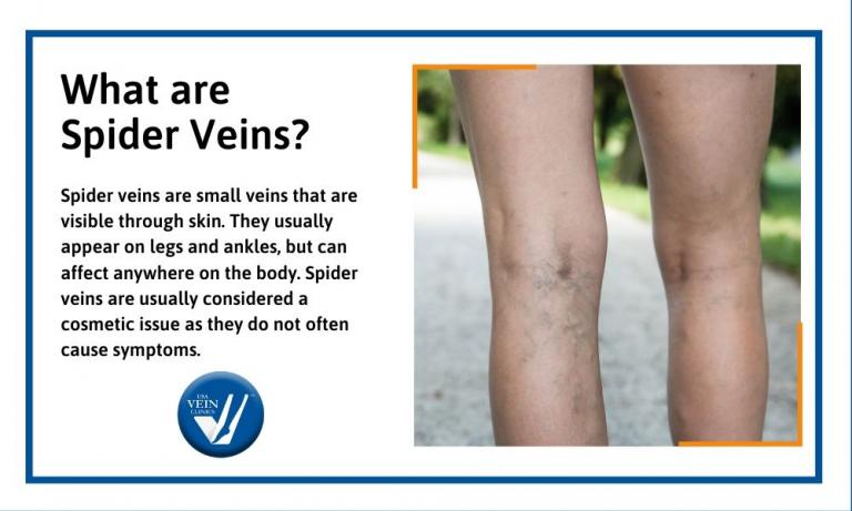 Facts About Spider Veins Blog Usa Vein Clinics