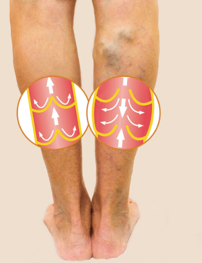 Minimally Invasive Treatment for Varicose Veins Now Available to