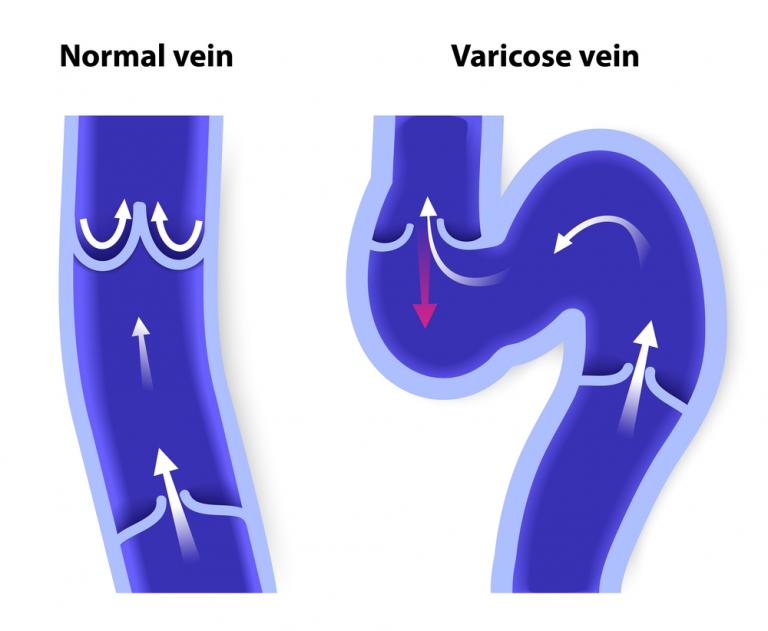 Vein Disease - Discover The Signs, Symptoms And Treatments