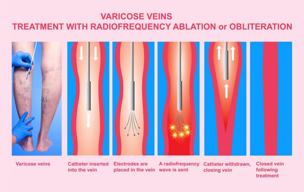 Varicose Vein Treatment And Procedures