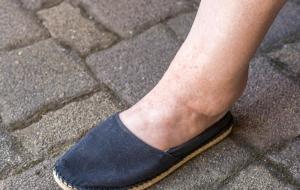 9 Causes Of Ankle Swelling & How To Treat Them | USA Vein Clinics