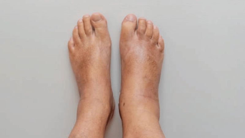 Signs Of Blood Clots In A Swollen Ankle: Causes &amp; Management