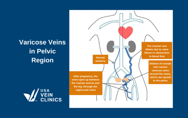 Varicose Veins During Pregnancy | The Complete Guide