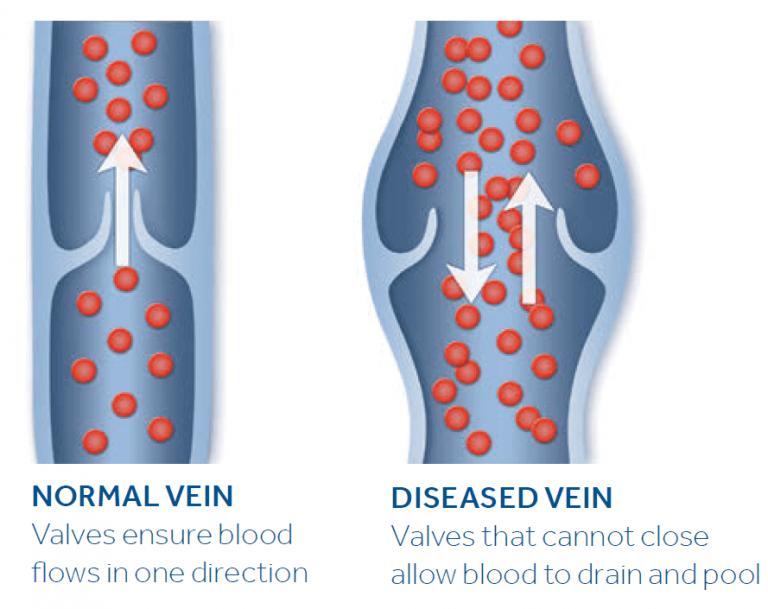 Venaseal Treatment For Varicose Veins