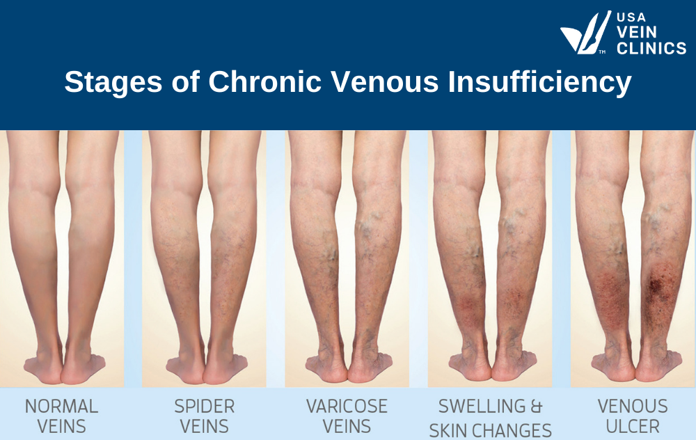 Venous Stasis Ulcer Stages