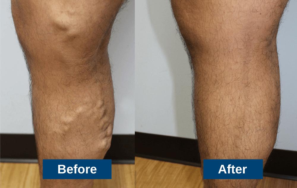 What are the Best Varicose Vein Treatment Options?