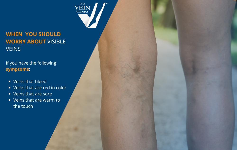 What You Need to Know About Chronic Venous Disease - Tactile Medical