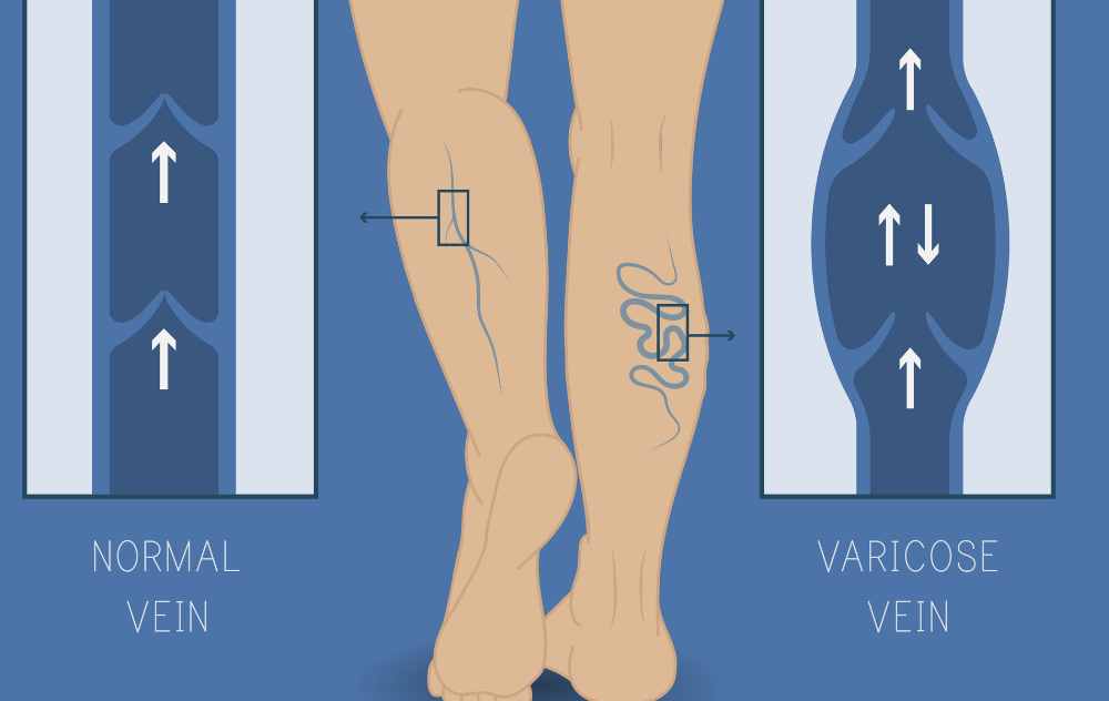 What Is Venous Reflux Disease Symptoms And Treatment