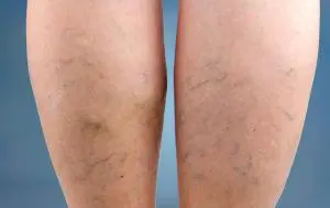 When to Worry About Varicose Veins Plus Treatment Options