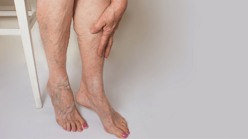 Why Are The Veins In My Feet Bulging? | USA Vein Clinics