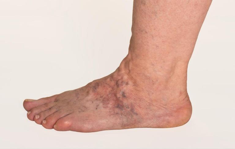 why-are-the-veins-in-my-feet-bulging-usa-vein-clinics