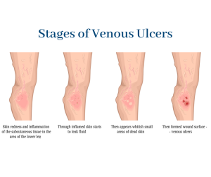 The Stages Of Chronic Venous Insufficiency (CVI)