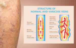 The Importance And Function Of Vein Valves | USA Vein Clinics