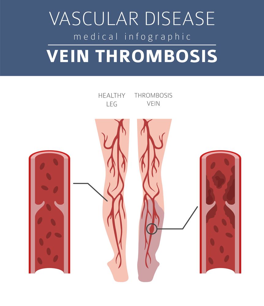 Deep Vein Thrombosis (DVT): Symptoms, Causes, & Treatment