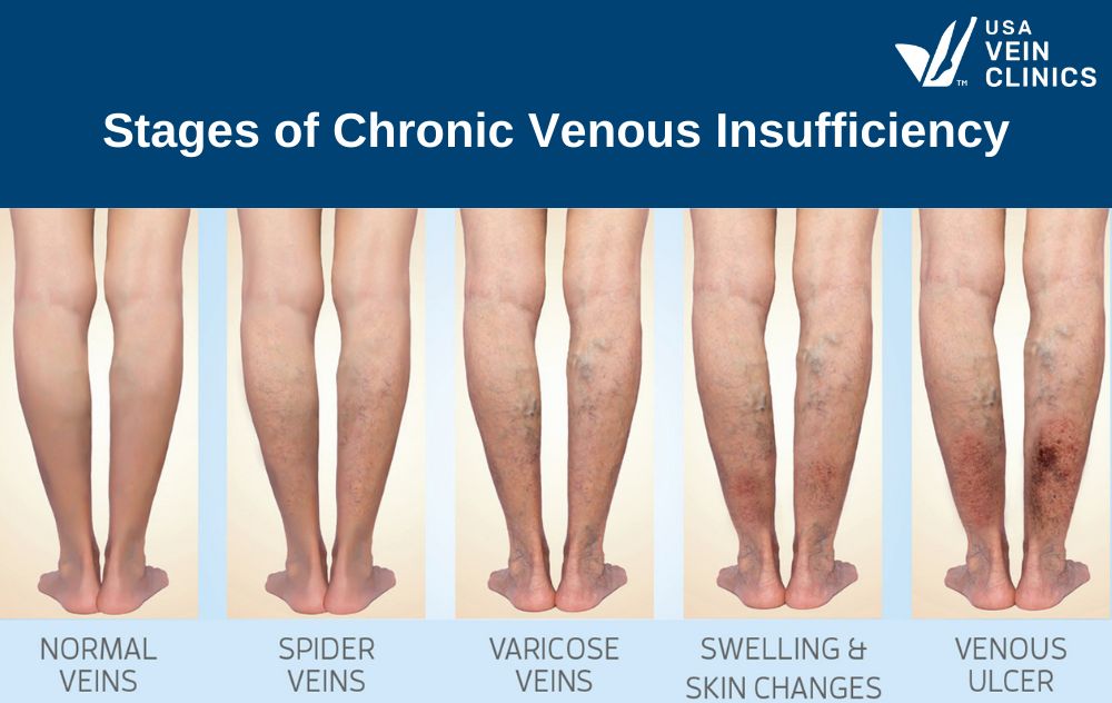 The Stages Of Chronic Venous Insufficiency (CVI)