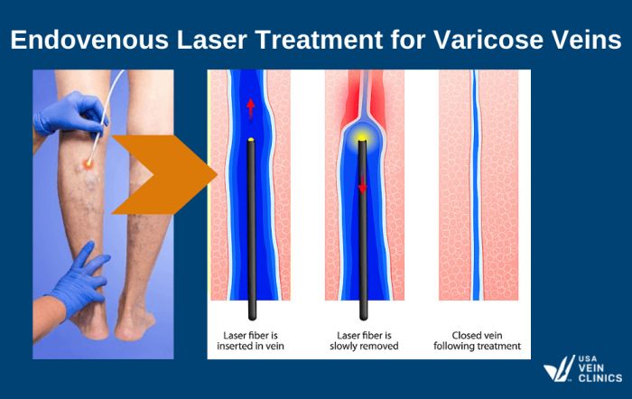 Best Treatment for Varicose Veins, Endovenous laser treatment