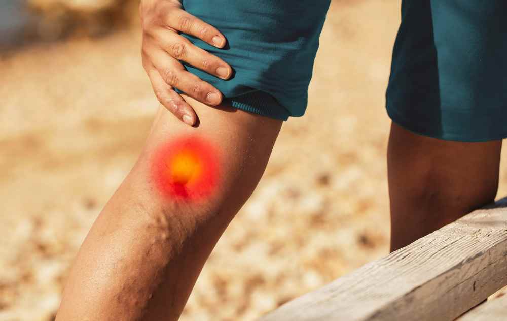 8 Tips On Relieving Varicose Vein Pain