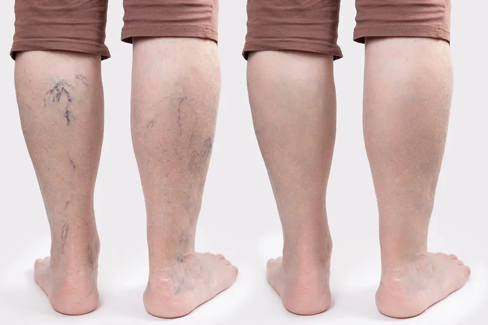 What To Expect After Varicose Vein Treatment