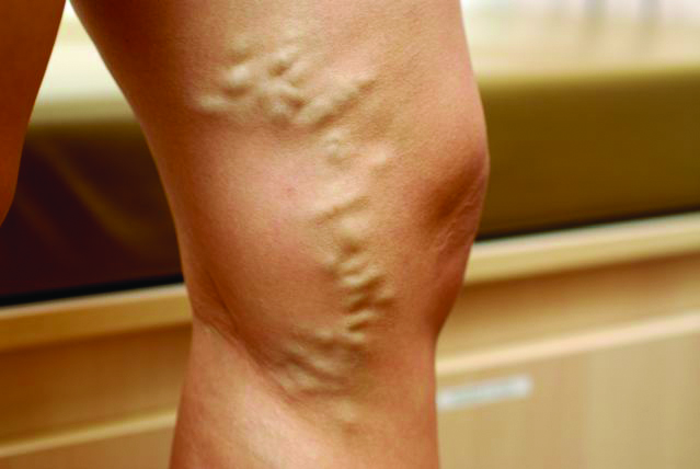 Varicose Veins: Causes, Symptoms, And Treatment