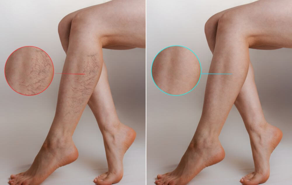 Here's How to Treat Varicose Veins - The Right Way
