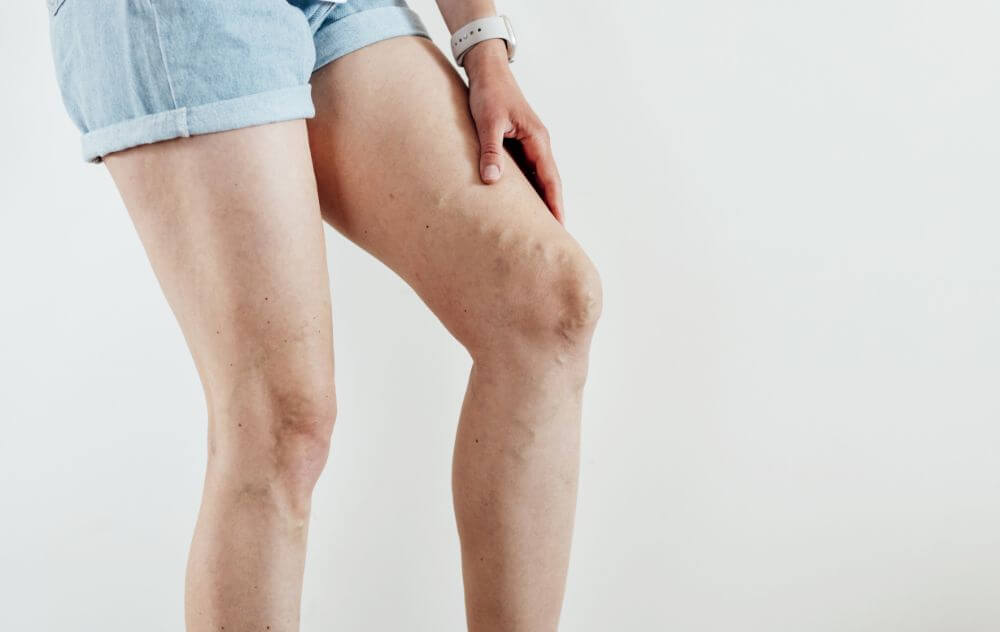 When Should You Start to Worry About Leg Pain?