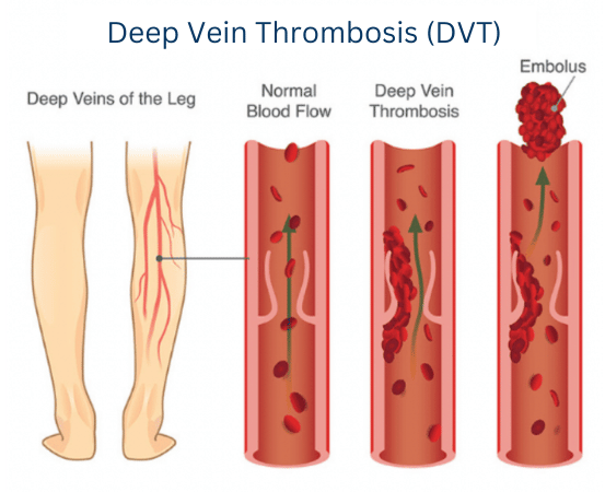 Deep Vein Thrombosis: Signs, Symptoms & Treatment For DVT